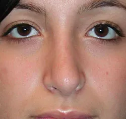 rhinoplasty after photo by michigan cosmetic surgery in southfield mi