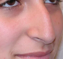 rhinoplasty before photo by michigan cosmetic surgery in southfield mi