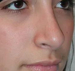 rhinoplasty after photo by michigan cosmetic surgery in southfield mi