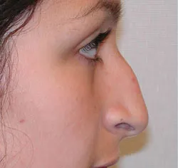 rhinoplasty before photo by michigan cosmetic surgery in southfield mi