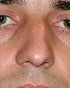 rhinoplasty before photo by michigan cosmetic surgery in southfield mi