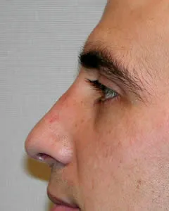 rhinoplasty after photo by michigan cosmetic surgery in southfield mi