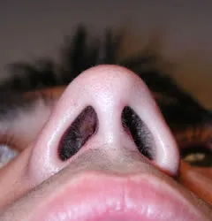 rhinoplasty after photo by michigan cosmetic surgery in southfield mi