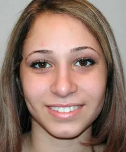 rhinoplasty after photo by michigan cosmetic surgery in southfield mi