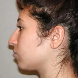 rhinoplasty before photo by michigan cosmetic surgery in southfield mi