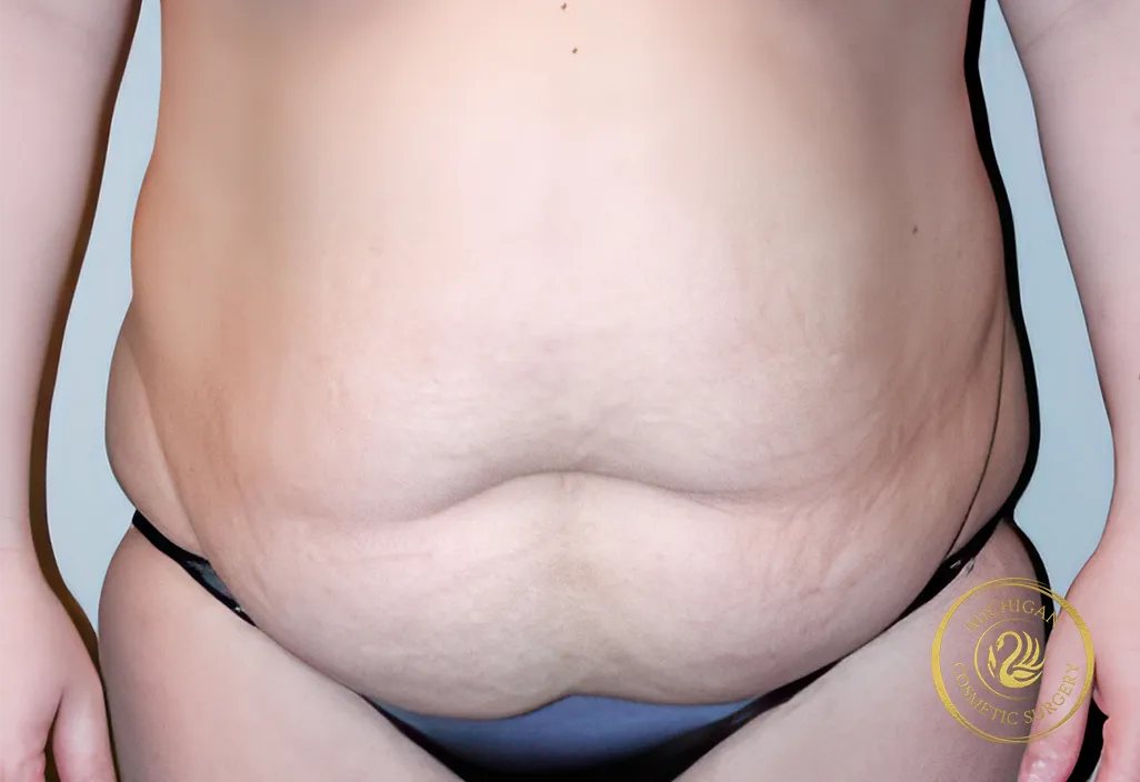 tummy tuck before photo by michigan cosmetic surgery in southfield mi