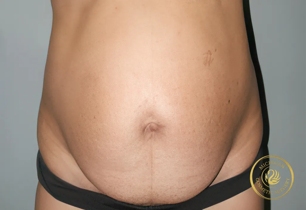 tummy tuck before photo by michigan cosmetic surgery in southfield mi