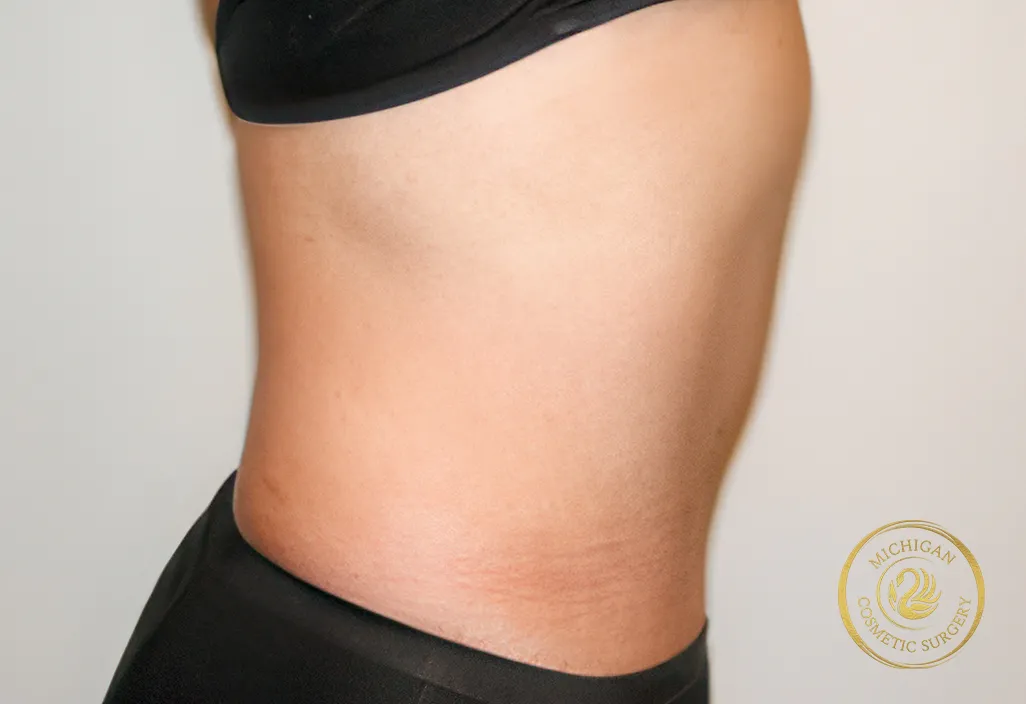 tummy tuck before photo by michigan cosmetic surgery in southfield mi