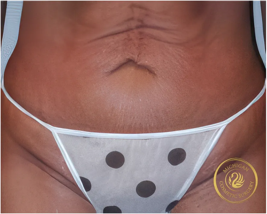 tummy tuck before photo by michigan cosmetic surgery in southfield mi