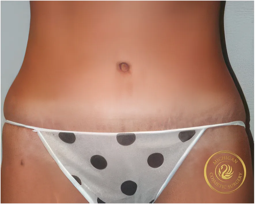 tummy tuck after photo by michigan cosmetic surgery in southfield mi