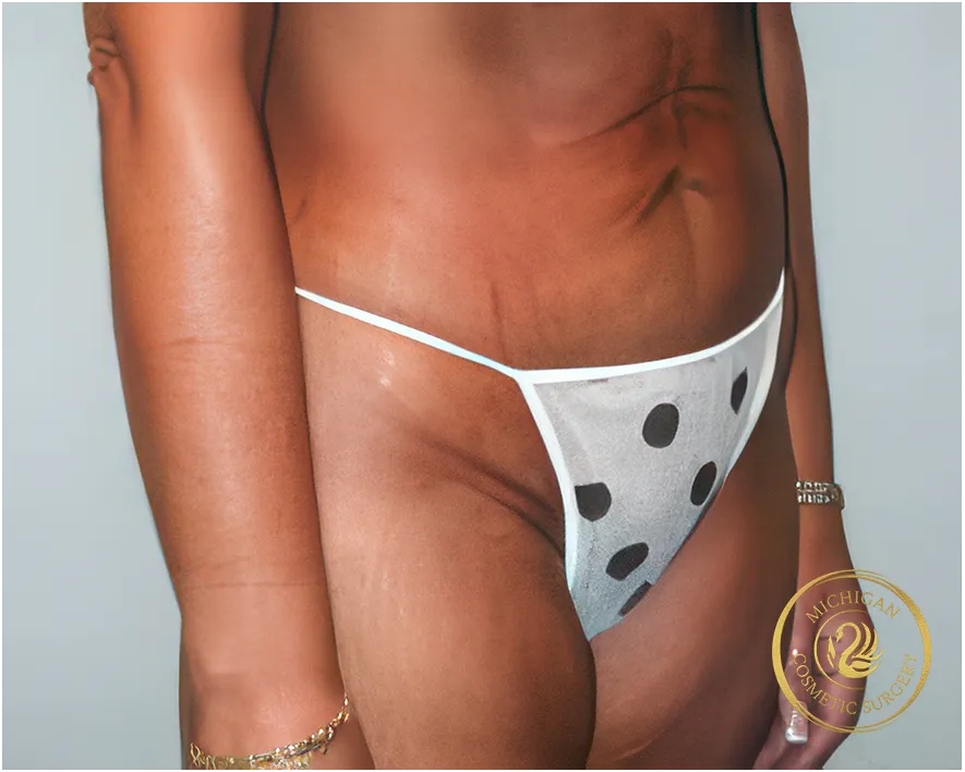 tummy tuck before photo by michigan cosmetic surgery in southfield mi