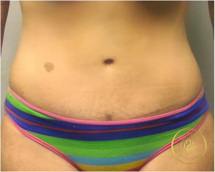 tummy tuck after photo by michigan cosmetic surgery in southfield mi