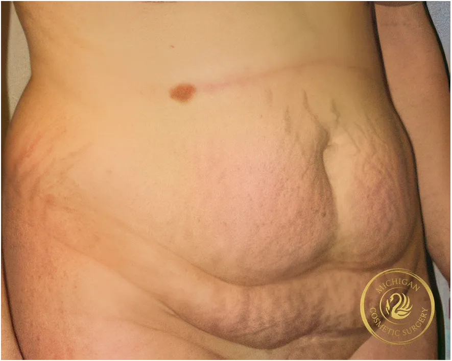 tummy tuck before photo by michigan cosmetic surgery in southfield mi