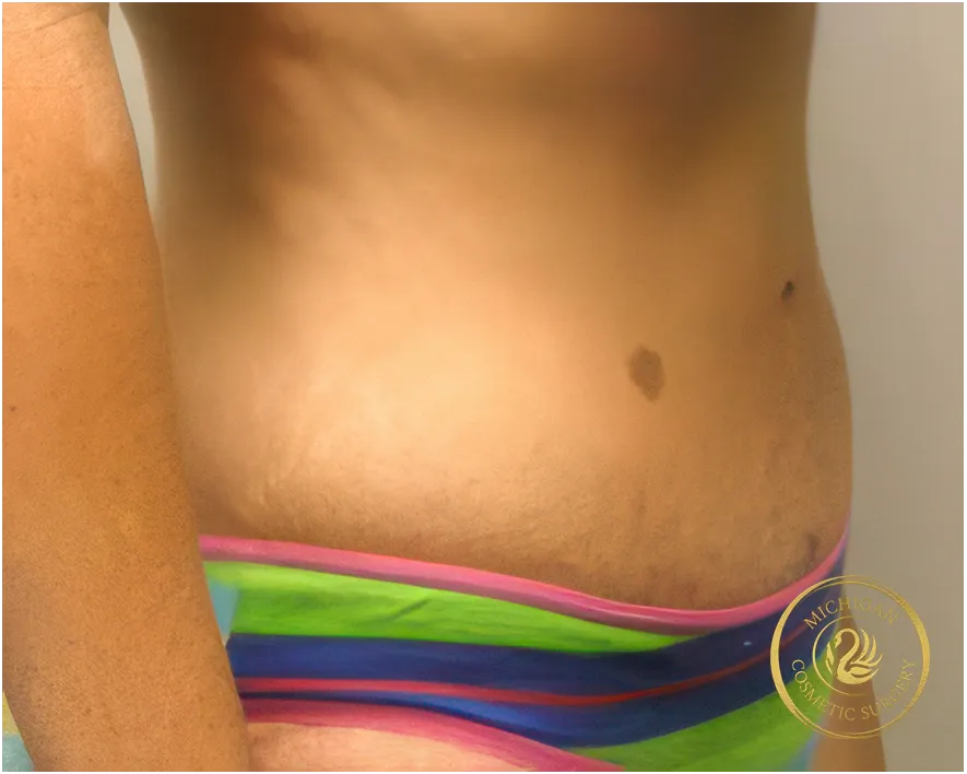 tummy tuck after photo by michigan cosmetic surgery in southfield mi