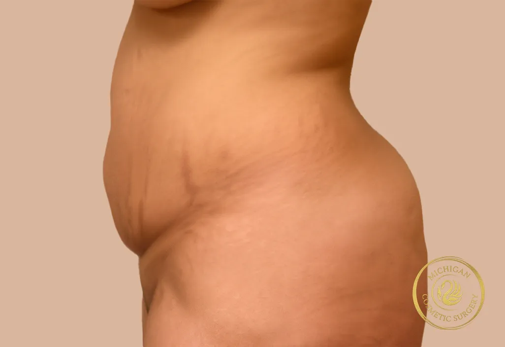 tummy tuck before photo by michigan cosmetic surgery in southfield mi