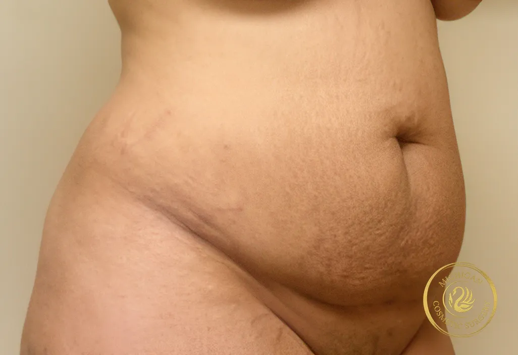 tummy tuck before photo by michigan cosmetic surgery in southfield mi