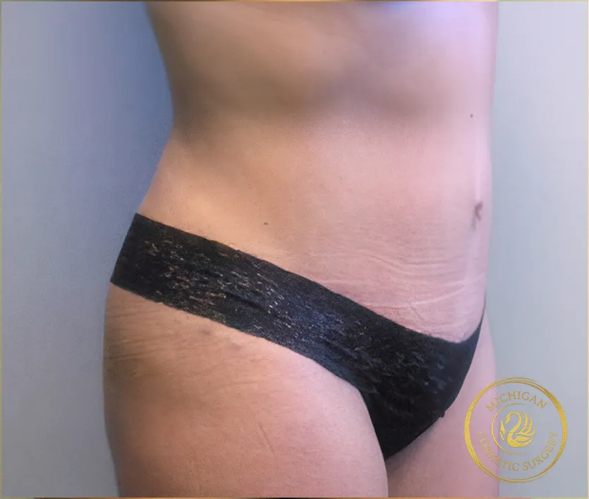 tummy tuck after photo by michigan cosmetic surgery in southfield mi