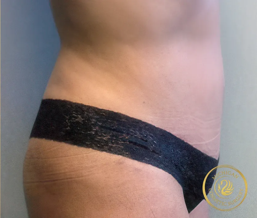 tummy tuck after photo by michigan cosmetic surgery in southfield mi