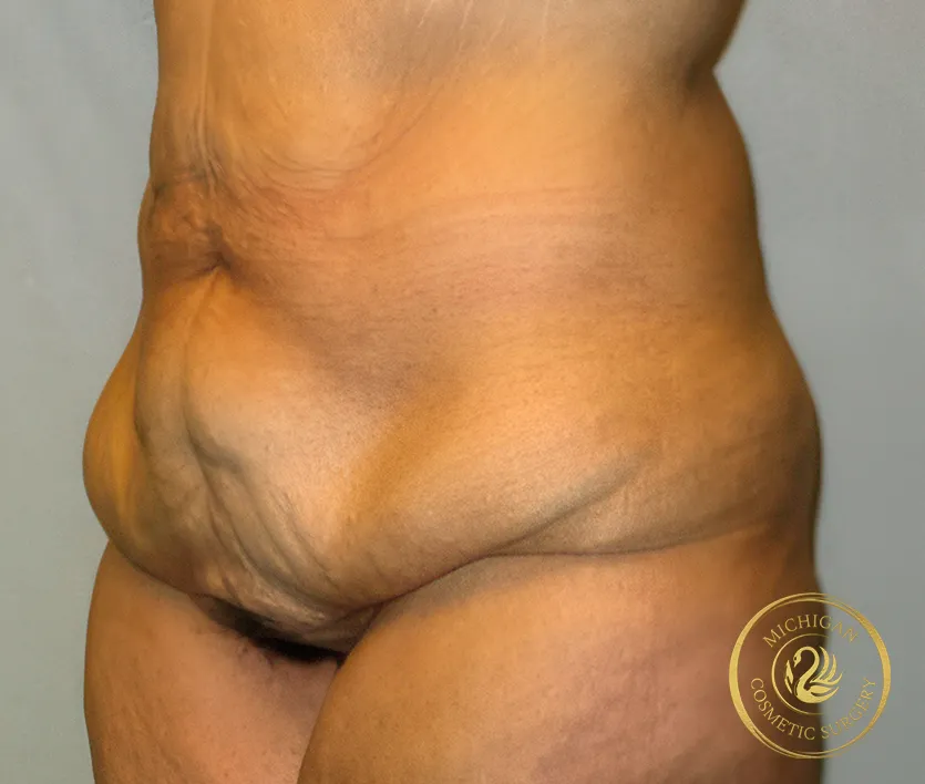 tummy tuck before photo by michigan cosmetic surgery in southfield mi