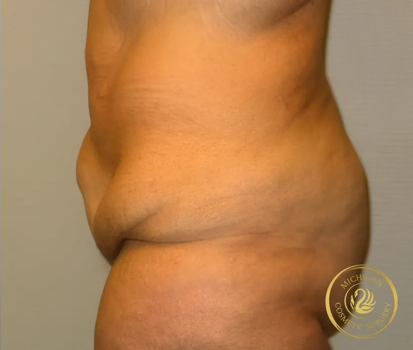 tummy tuck before photo by michigan cosmetic surgery in southfield mi