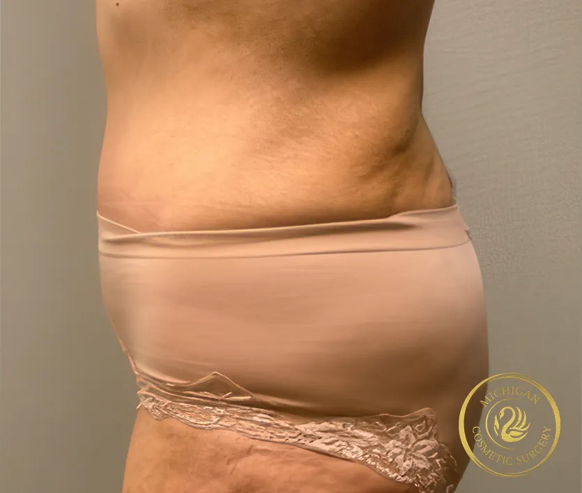 tummy tuck after photo by michigan cosmetic surgery in southfield mi