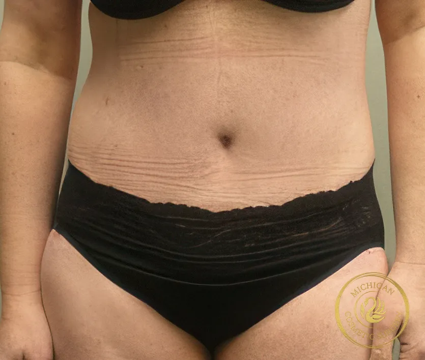 tummy tuck after photo by michigan cosmetic surgery in southfield mi