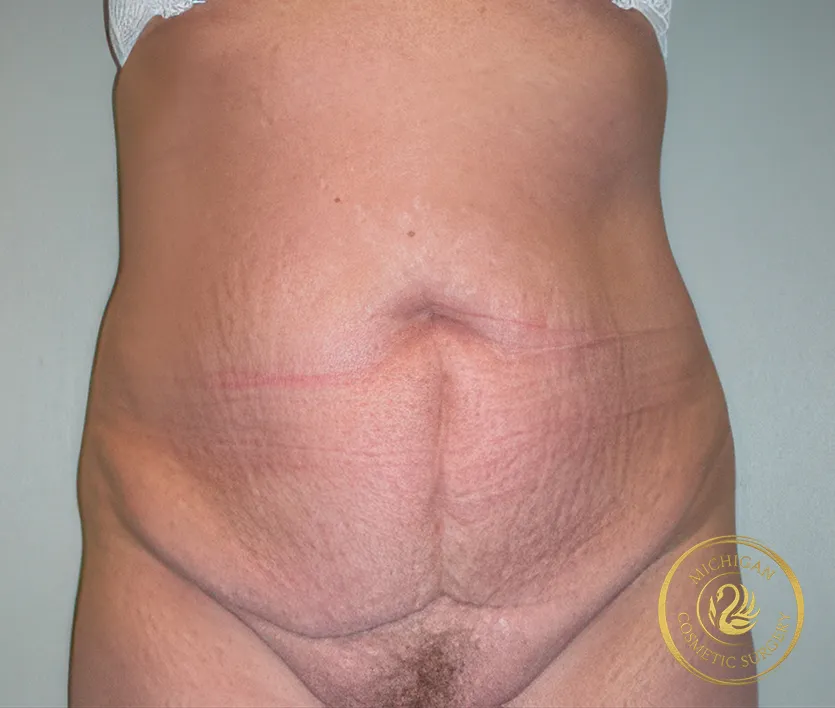 tummy tuck before photo by michigan cosmetic surgery in southfield mi