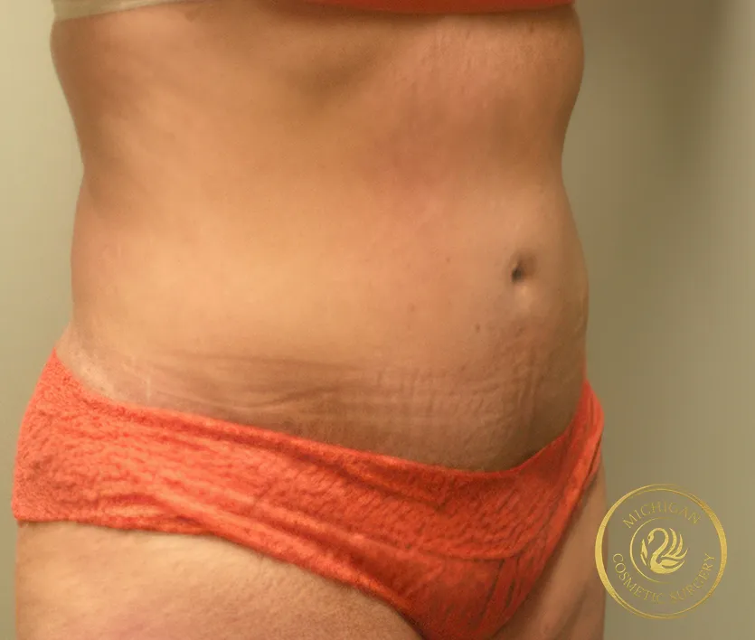 tummy tuck before photo by michigan cosmetic surgery in southfield mi