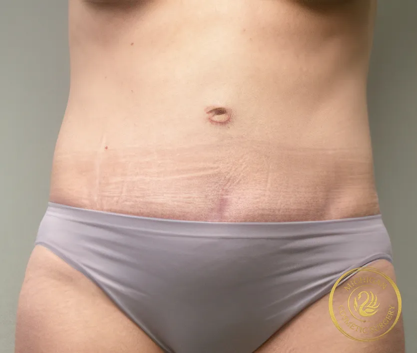 tummy tuck after photo by michigan cosmetic surgery in southfield mi