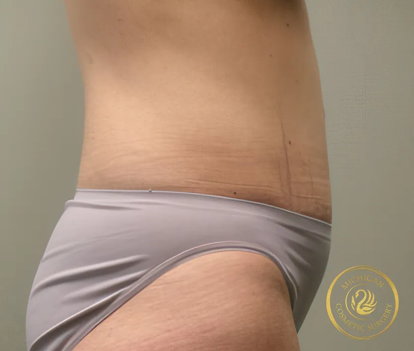 tummy tuck after photo by michigan cosmetic surgery in southfield mi