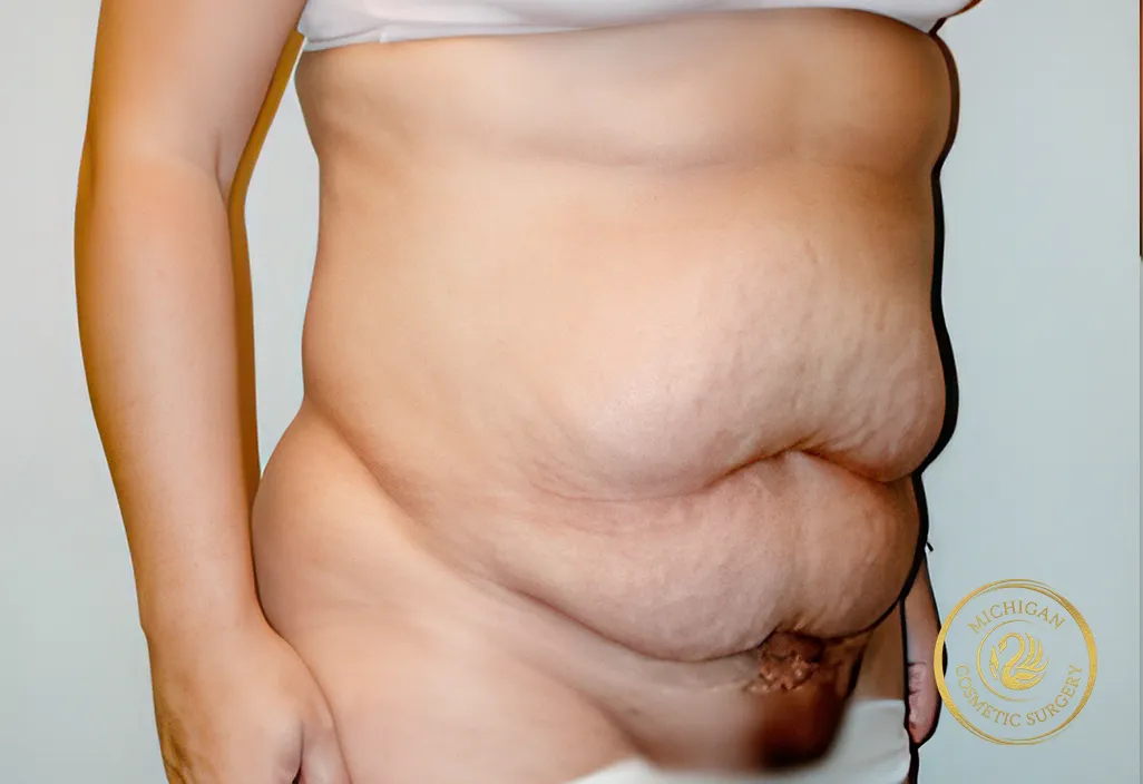 tummy tuck before photo by michigan cosmetic surgery in southfield mi