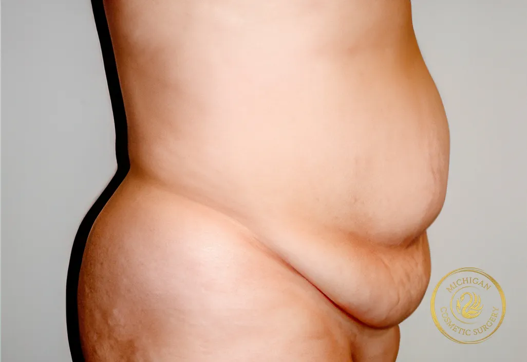 tummy tuck before photo by michigan cosmetic surgery in southfield mi