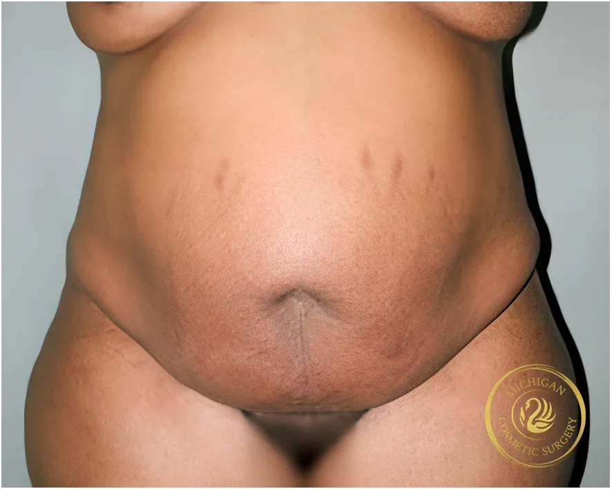 tummy tuck before photo by michigan cosmetic surgery in southfield mi
