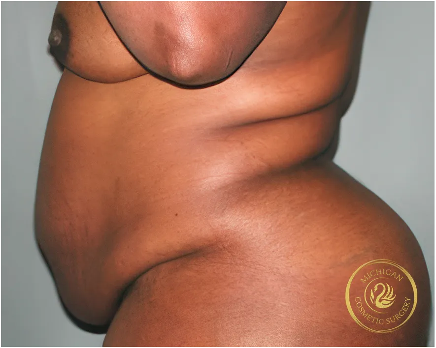 tummy tuck before photo by michigan cosmetic surgery in southfield mi
