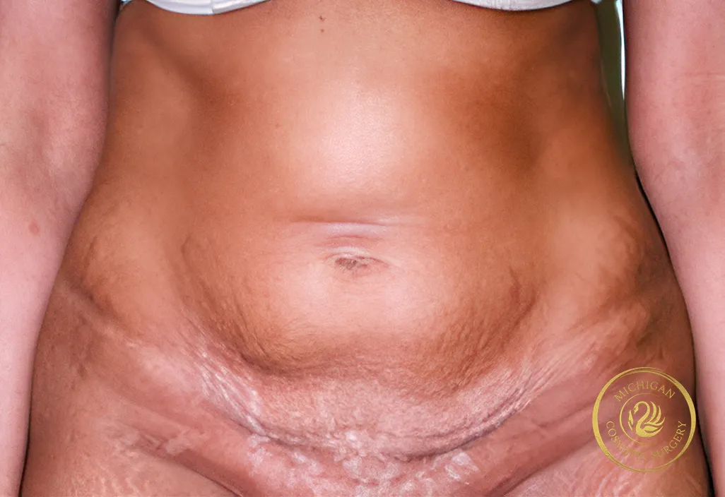 tummy tuck before photo by michigan cosmetic surgery in southfield mi