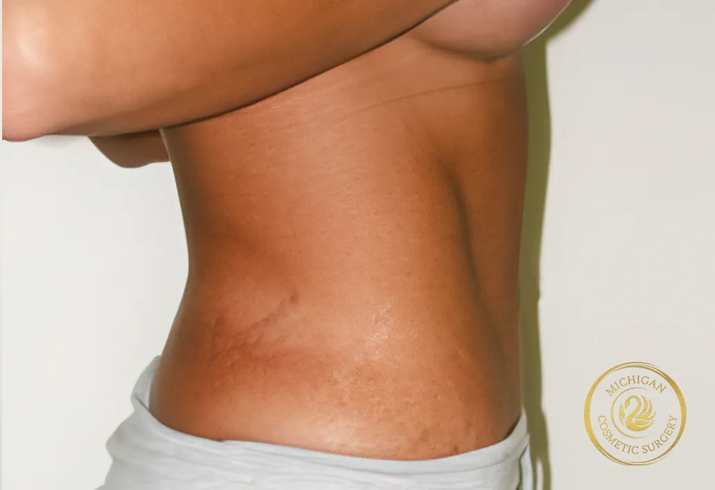 tummy tuck after photo by michigan cosmetic surgery in southfield mi