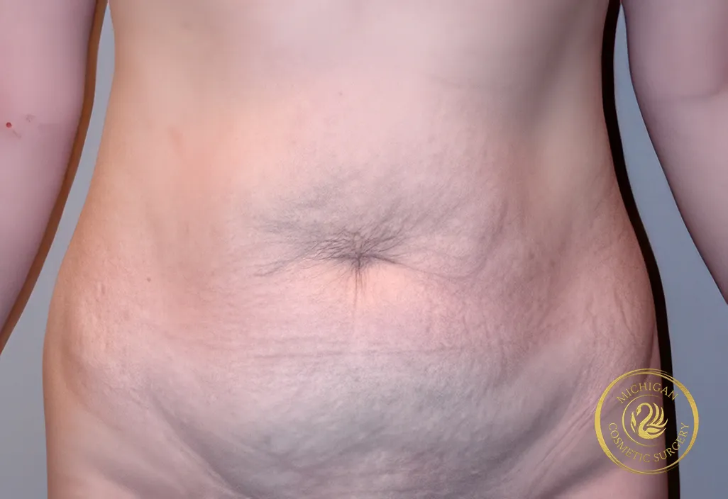 tummy tuck before photo by michigan cosmetic surgery in southfield mi