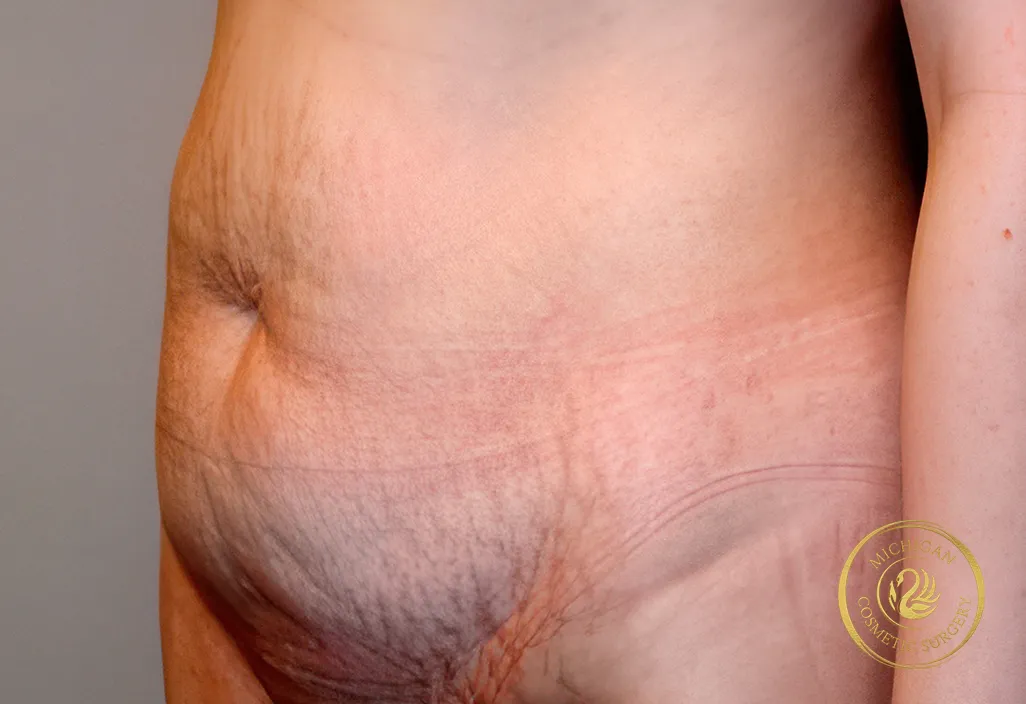 tummy tuck before photo by michigan cosmetic surgery in southfield mi