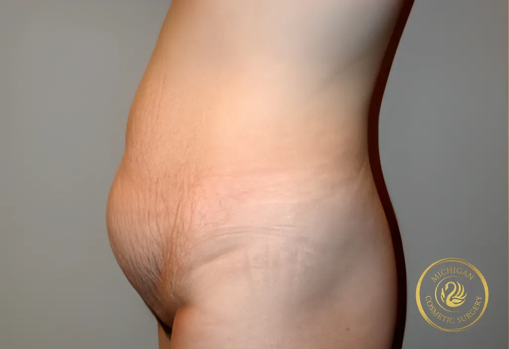 tummy tuck before photo by michigan cosmetic surgery in southfield mi