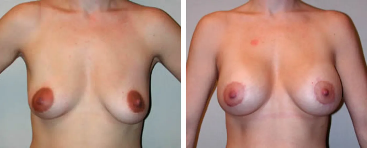 Breast Aug Crescent Periareolar lift a