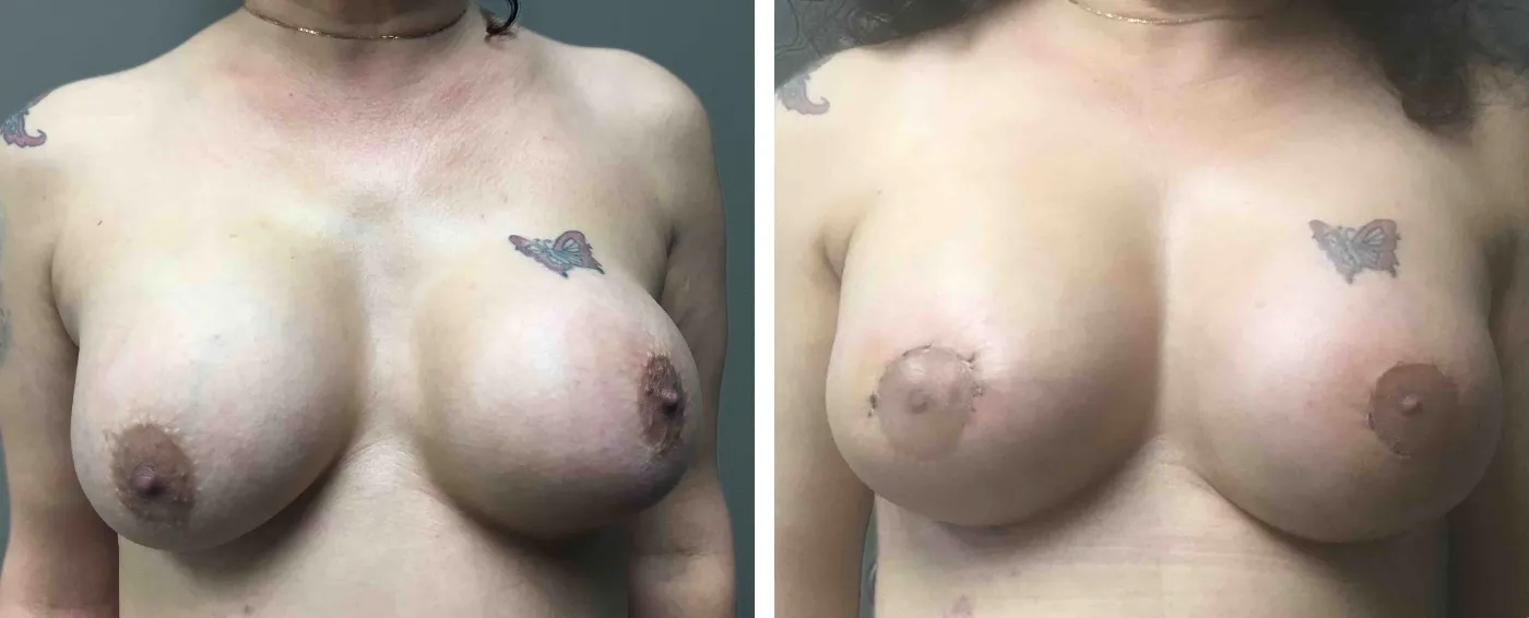 Breast Implant Removal and Replacement in Michigan a