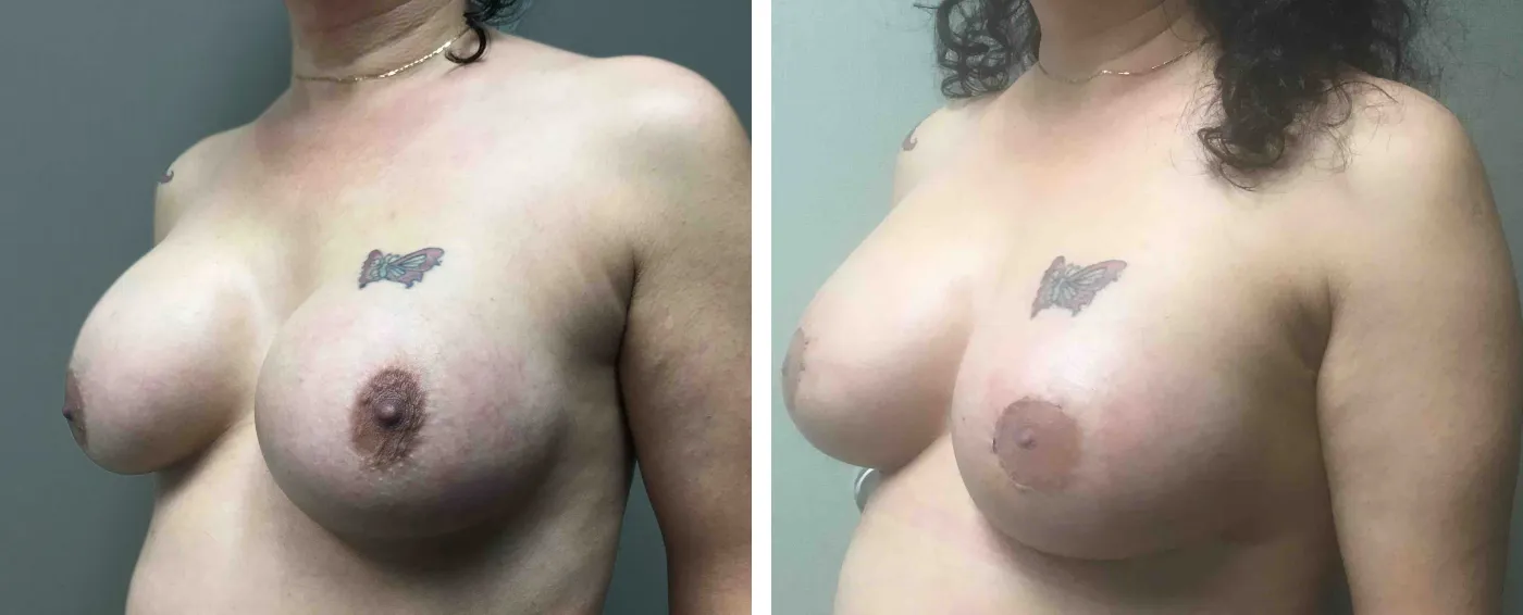 Breast Implant Removal and Replacement in Michigan b