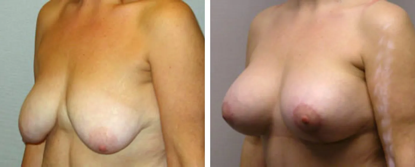 Breast Augmentation with Lollipop Lift a