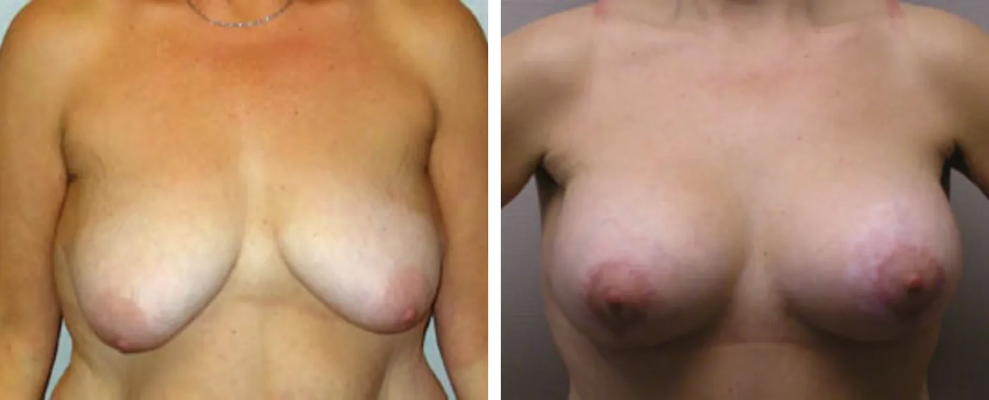 Breast Augmentation with Lollipop Lift c