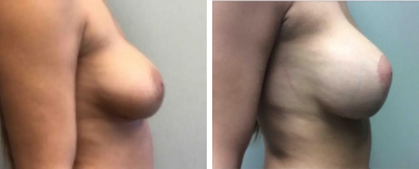 Breast Implant Removal and Replacement in Michigan c