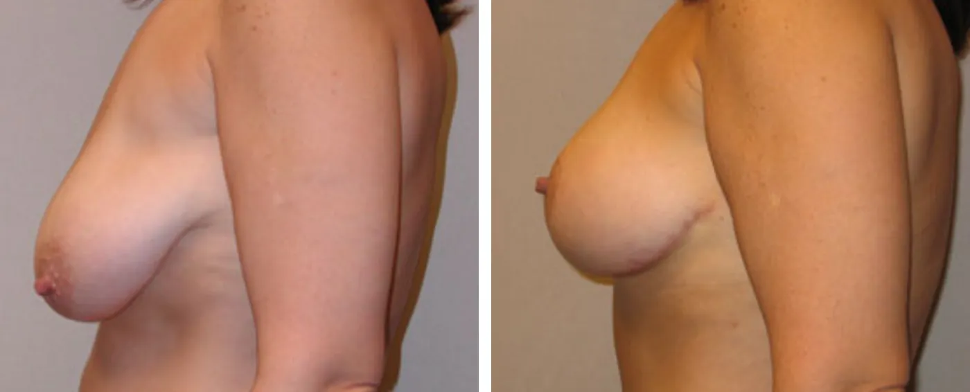 Breast lift c