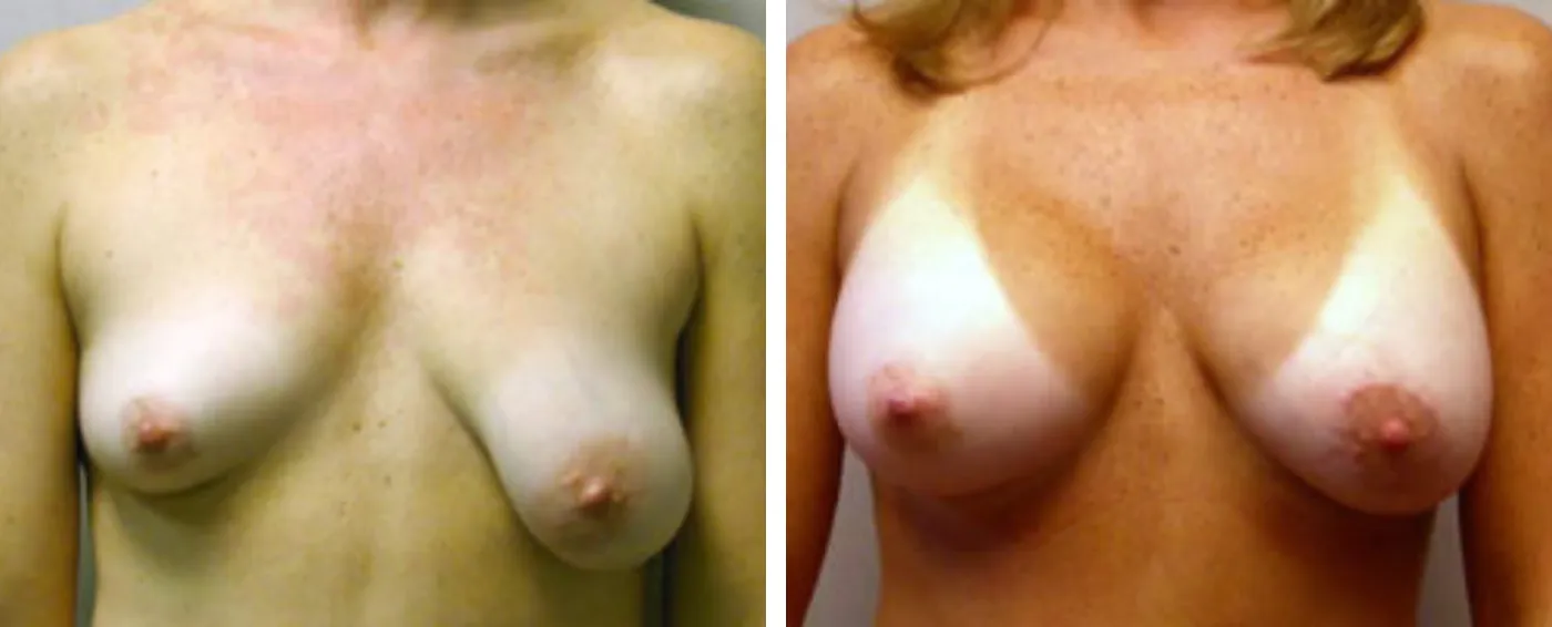 Breast Aug Periareolar lift a