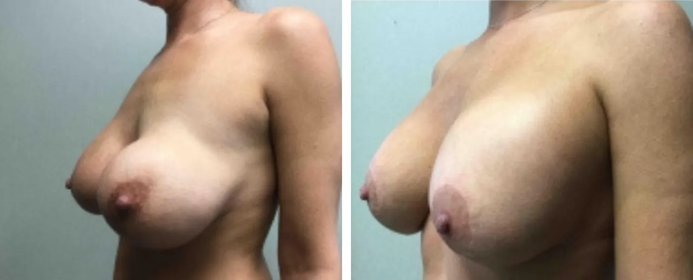 Breast Implant Removal and Replacement in Michigan b