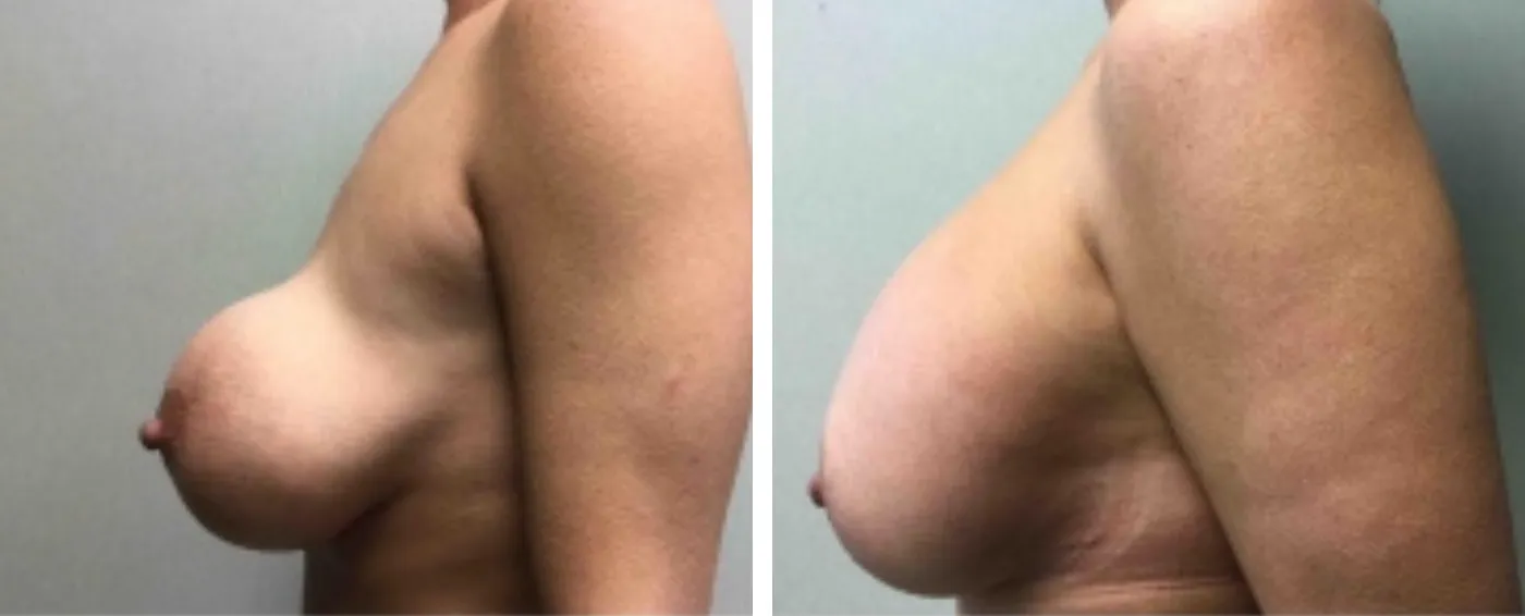 Breast Implant Removal and Replacement in Michigan c