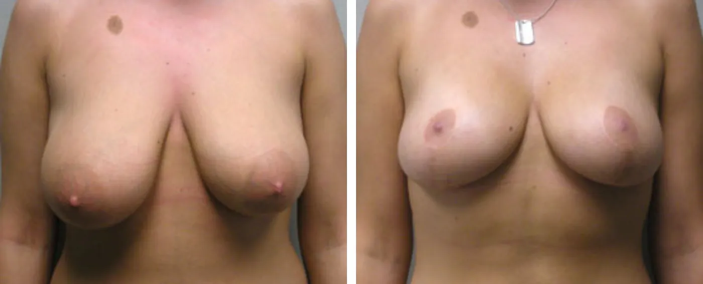 Breast lift a